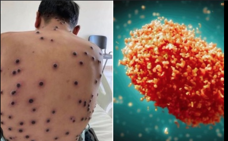 México refuerza vigilancia epidemiológica ante la amenaza de Mpox